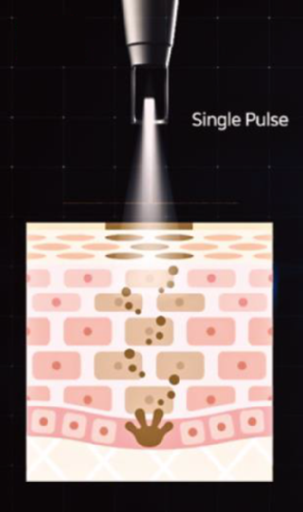 Single pulse treatment visual